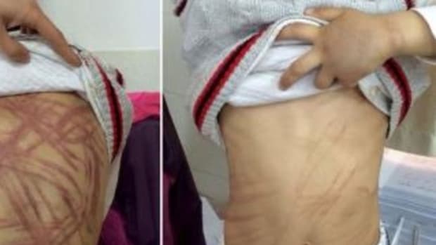 Teachers Discovery How 9-Year-Old Got These Scars, Immediately Call The Cops (Photos) Promo Image