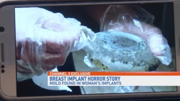moldy breast implants
