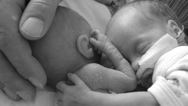 Girl Survives Birth Thanks To Healthy Twin (Photos) Promo Image