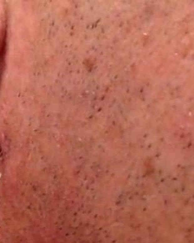 Man Shows The World What Happens When You Extract An Ingrown Hair