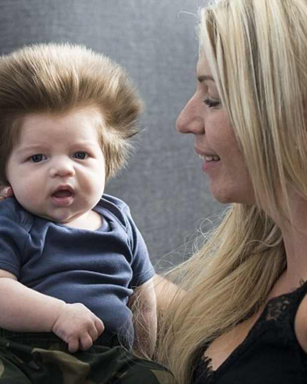 Baby's Wild Hair Caused By Genetic Disorder (Photos 