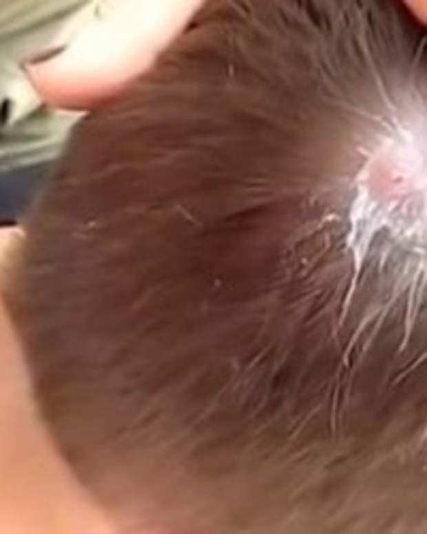 Man Notices Bump On Head After Overseas Trip Pulls Out What Was