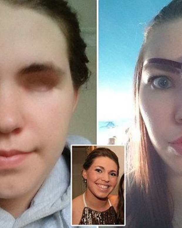 Woman Loses Eye To Rare Form Of Ocular Melanoma Opposing Views My XXX