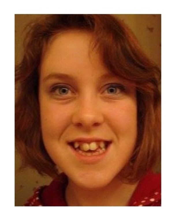 Photos Show Shocking Transformation Of Girl With Jaw Deformity 