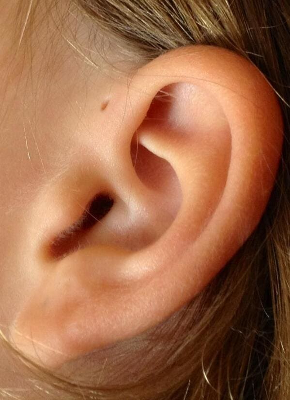 This Is Why Some People Have Holes In Their Upper Ears (Photo