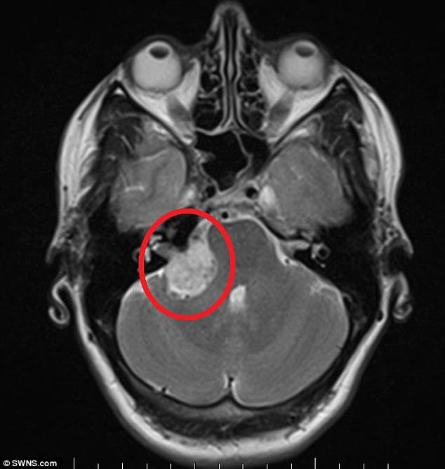 Woman Diagnosed With Tumor Near Brain After Checking ...