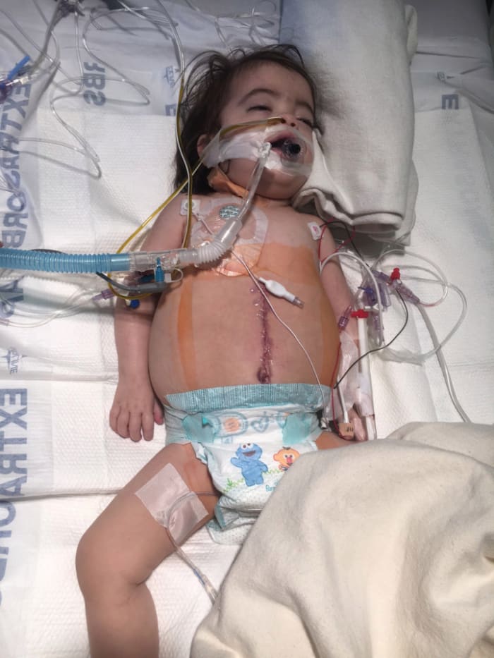 Rare Disease Makes Baby Look Pregnant (Photos) Opposing