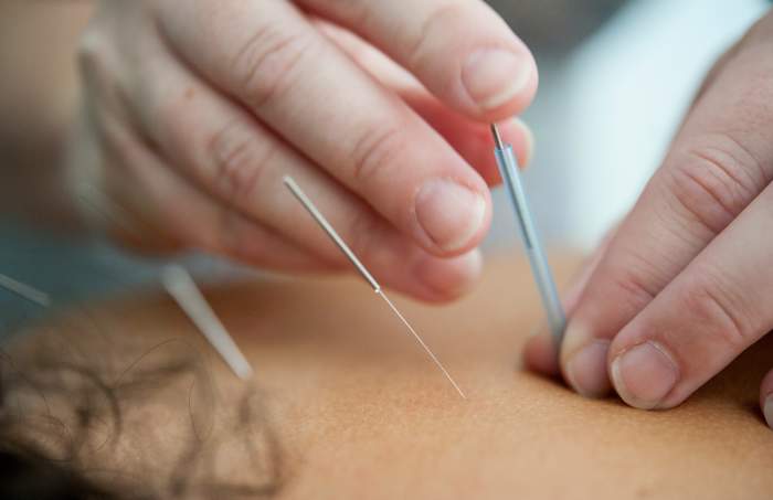 A person doing acupuncture on a person's back, Photo Credit: Unsplash
