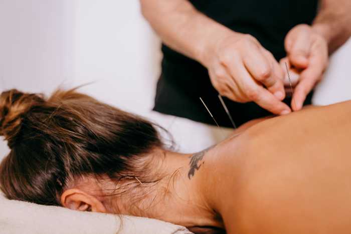 Someone putting acupuncture needles into a person's back, Photo Credit: Pexels