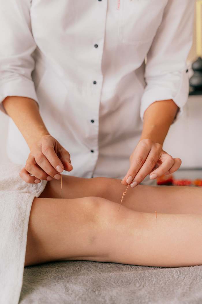 Person putting acupuncture needles in a person's knees, Photo Credit: Pexels