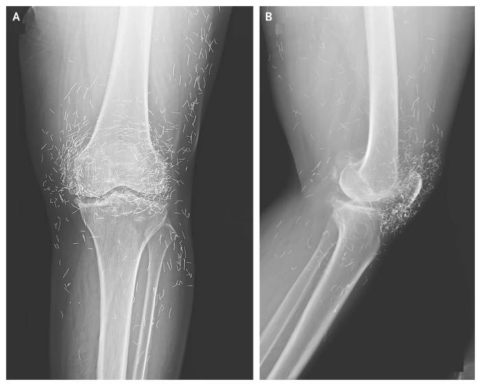 A X-ray of the patient’s knee showing acupuncture needles embedded in the tissue, Photo Credit: Reddit