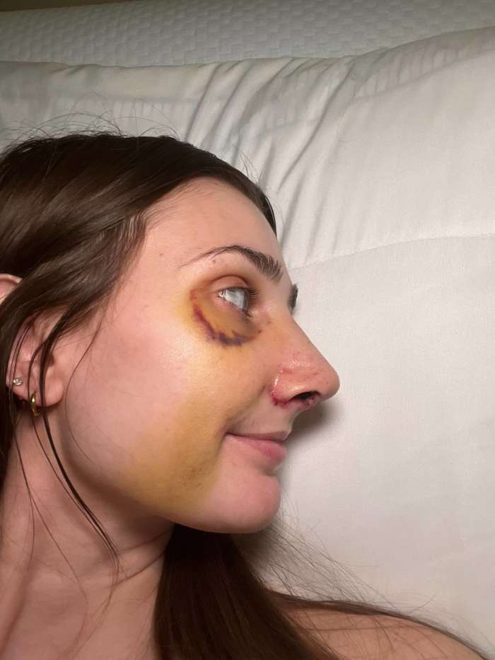 Devyn Aiken several days after her nose surgery, Photo Credit: doseofdevy/Tiktok