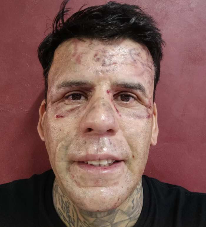 Leandro de Souza's face after his fifth session of laser treatment, Photo Credit: leandrodesouzabless/Instagram