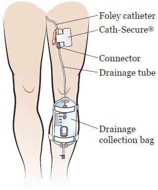 an illustration of a foley catheter being worn, Photo Credit: Alice Vaughn/X