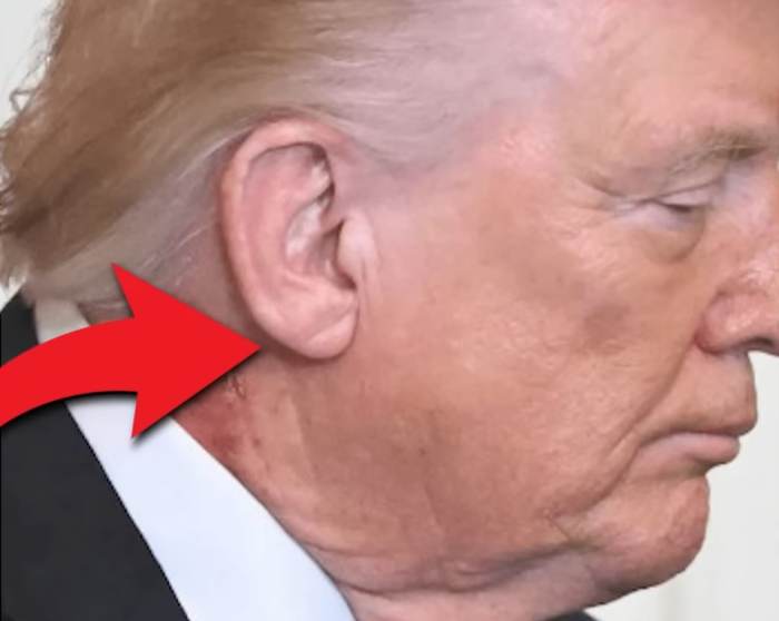 Close up shot of President Donald Trump's ear with what looks like a diagonal earlobe crease, Photo Credit: David Pakman Show/Youtube
