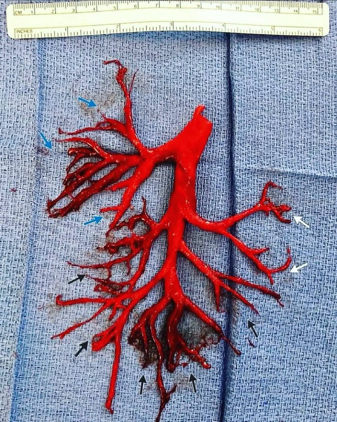 A blood clot coughed up by a patient perfectly shaped to the lung’s cavity it filled, Photo Credit: doctors__squad/Instagram