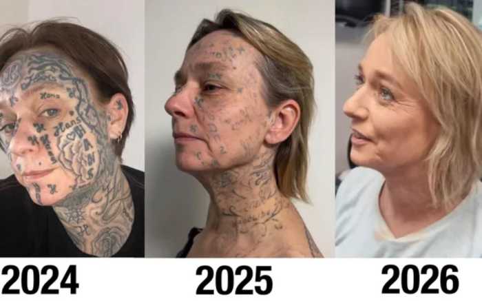 Progress comparison photos of Joke from before and after removing her tattoos; Photo Credit: 75 Secondes/X