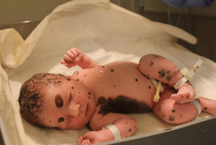 Newborn Dylan laying down in the hospital with large moles visible all over his body, Photo Credit: Facebook/Dylan's Amazing Journey
