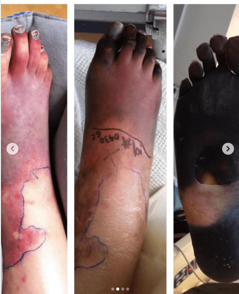 Gangrene damage to Lauren Wasser's feet, Lauren Wasser Photo Credit: theimpossiblemuse/Instagram