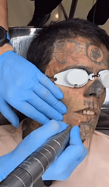 Leandro de Souza getting his face tattoos removed with laser procedure, Photo Credit: leandrodesouzabless/Instagram