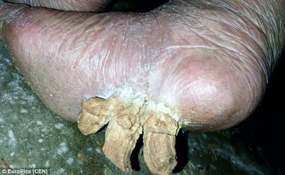 Woman Claims 'Toenail Horns' Are Growing Out Of Her Feet - Opposing Views