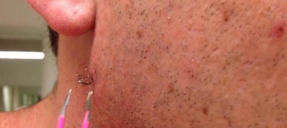 Here S What Happens When You Extract A Months Old Ingrown Hair