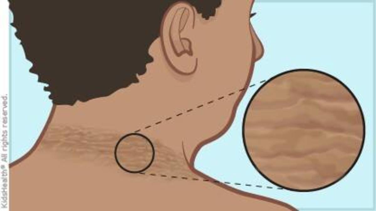 If You Find Dark, Discolored Skin On Your Neck, You May Have This Skin