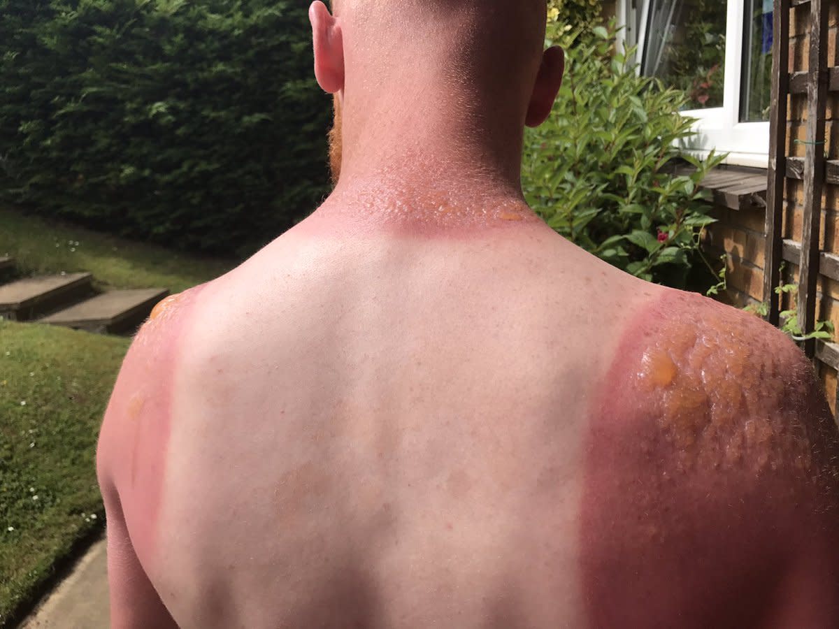 Man Posts Shocking Images Of Second Degree Sunburn (Photos) - Opposing