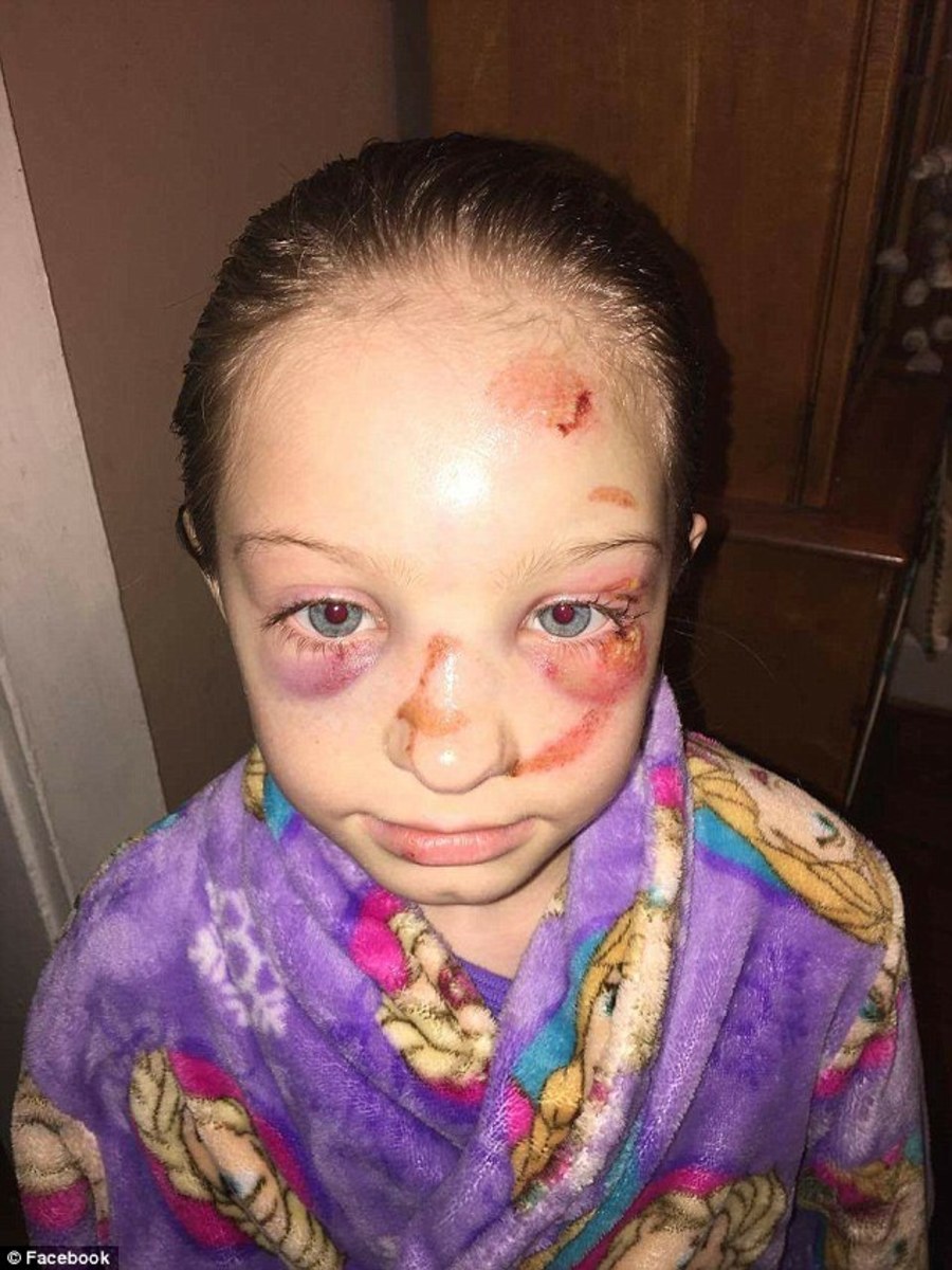 School Covers Up Bully S Attack On 9 Year Old Girl Photos