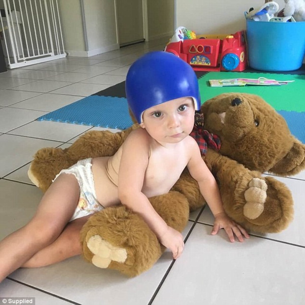 Baby Has Part Of Skull Removed After Falling Off Couch Photos