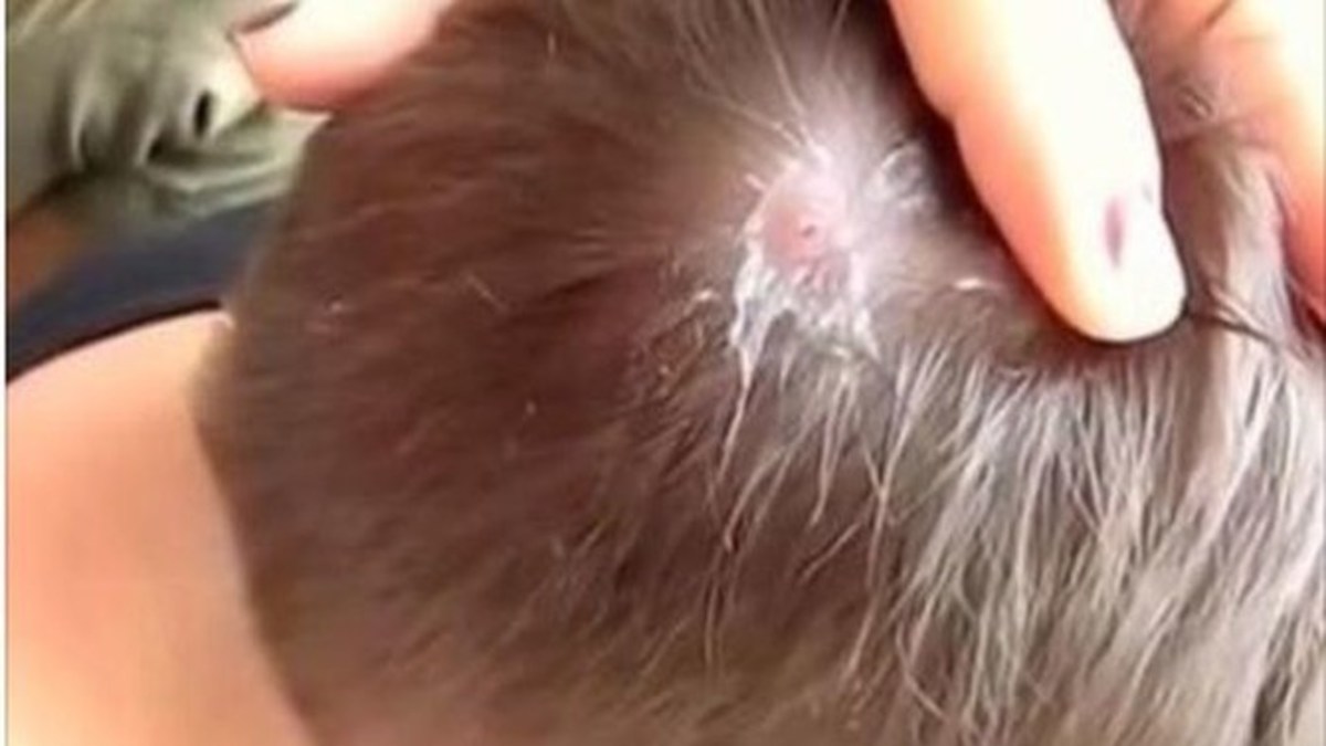 Man Notices Bump On Head After Overseas Trip Pulls Out What Was