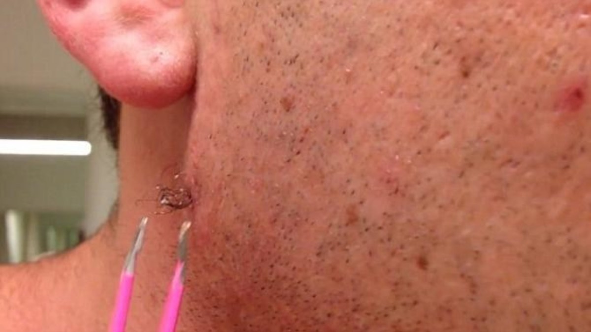 Man Shows The World What Happens When You Extract An Ingrown Hair