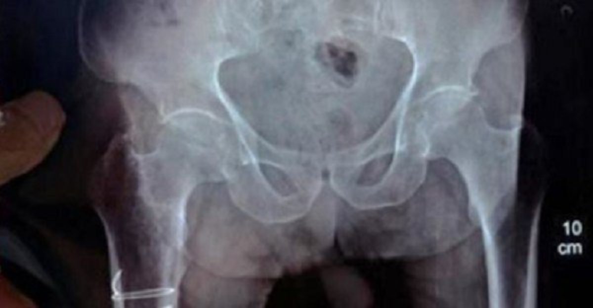 Elderly Vet Complaining Of Pains In Abdomen Gets Unexpected Diagnosis (Photos) Promo Image