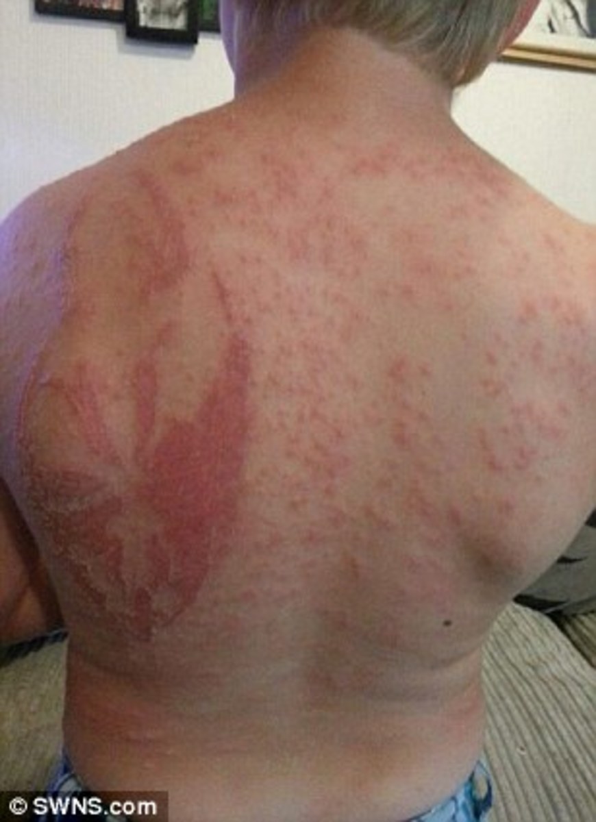 Henna Tattoo Causes 'Worst Skin Reaction' Doctor Had Ever Seen
