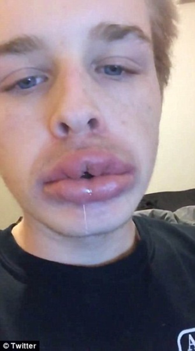 New Kylie Jenner Challenge Leads To Bruised Lips Photo Opposing