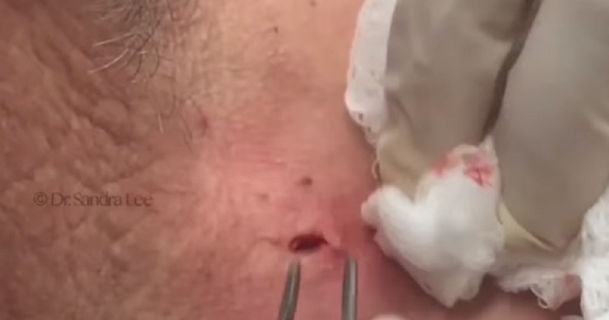 Patient Shocked By What Doctor Removes After Huge Cyst