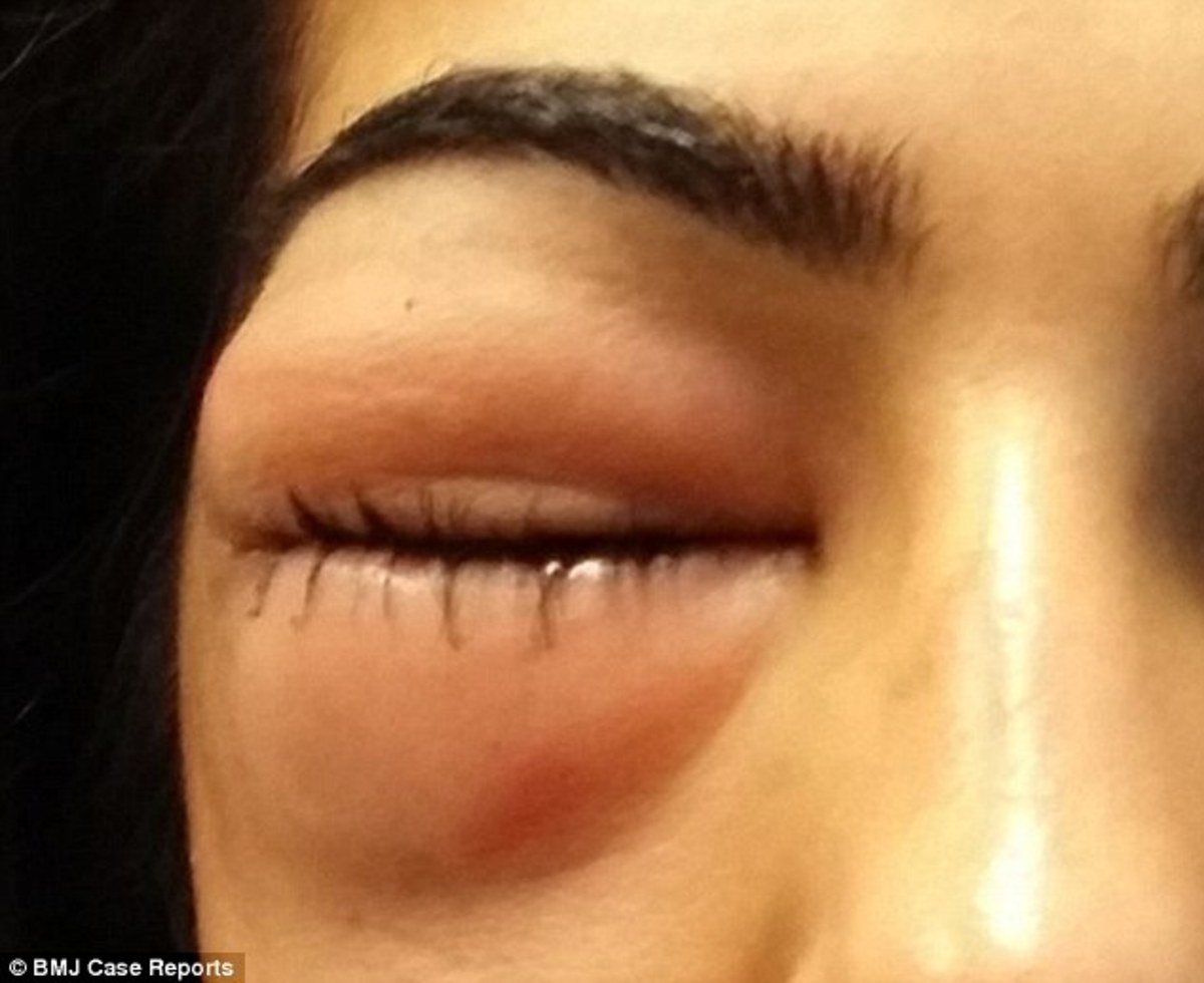 Woman's Eye Swells To Size Of A Golf Ball After 'Forcefully' Blowing