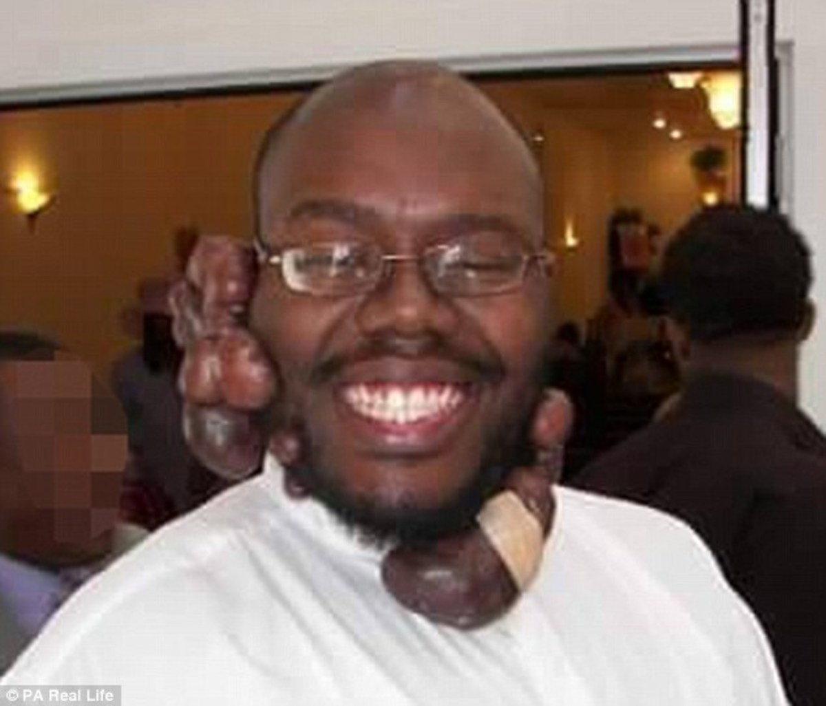 Strangers Help Man Remove Childhood Scars For Wedding - Opposing Views