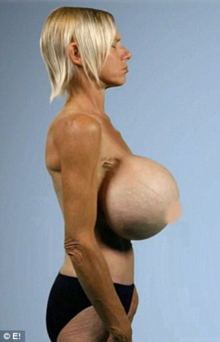Reconstructive Tits - Dee Stein, 53, Undergoes Reconstructive Surgery To Remove 30 ...