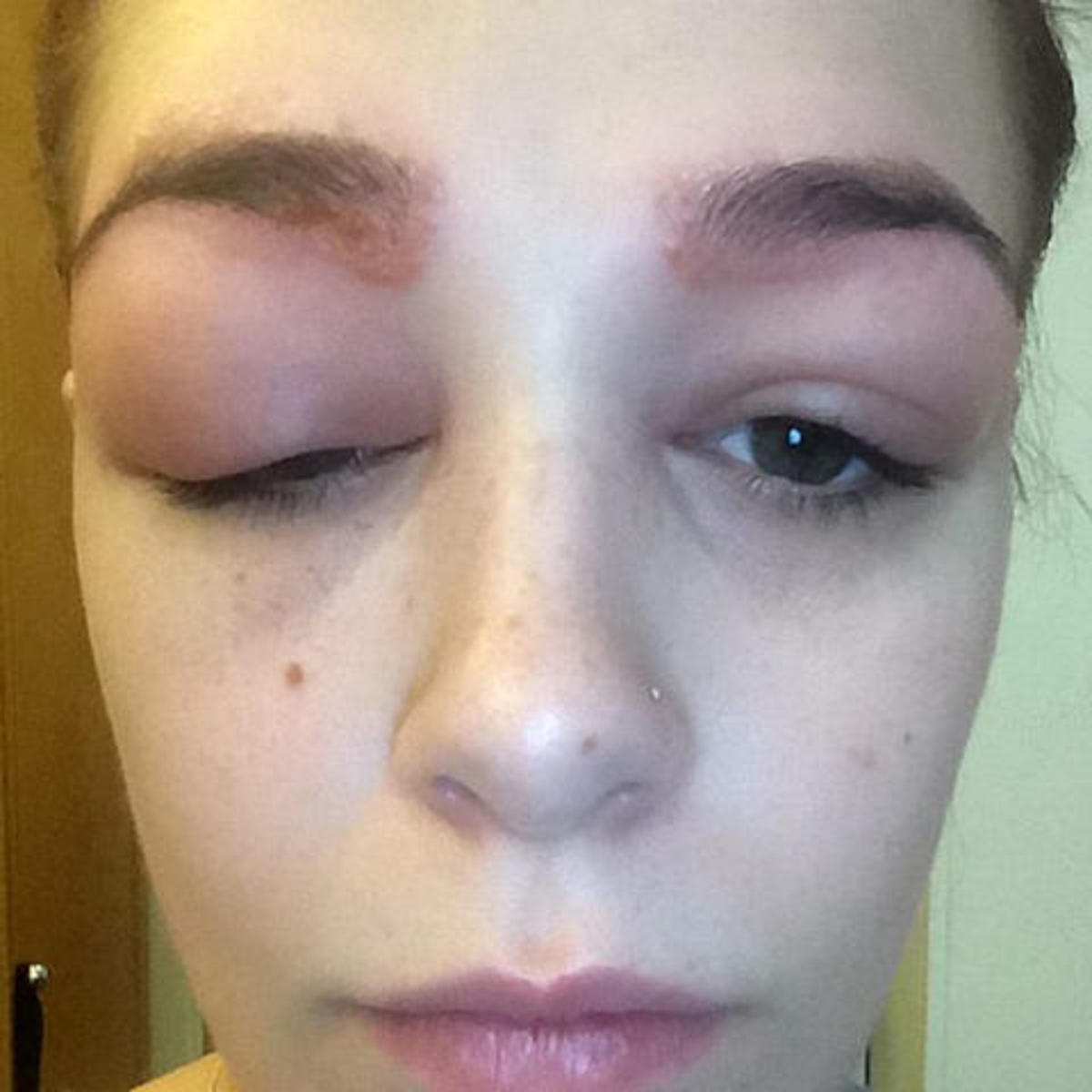 British Teen Suffers Dramatic Allergic Reaction To Eyebrow Procedure Opposing Views