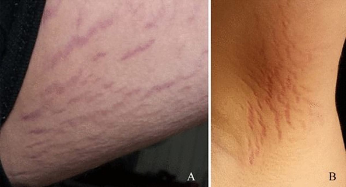 cat-scratch-disease-1