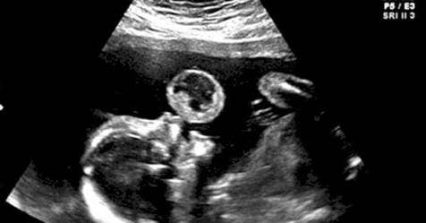 Mom Thinks Her Baby Is Blowing Bubble In Ultrasound, Then Doctors Discover What It Really Is - Vimarsana News