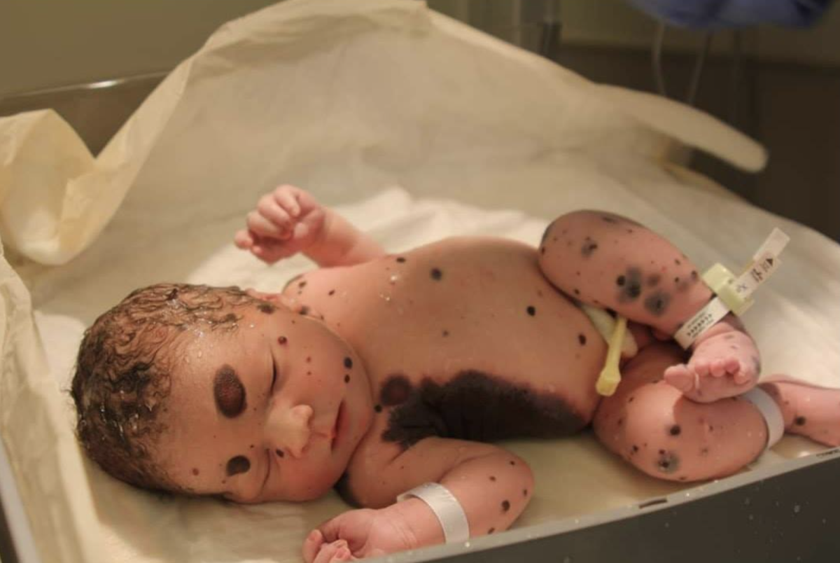 Newborn Dylan laying down in the hospital with large moles visible all over his body, Photo Credit: Facebook/Dylan's Amazing Journey