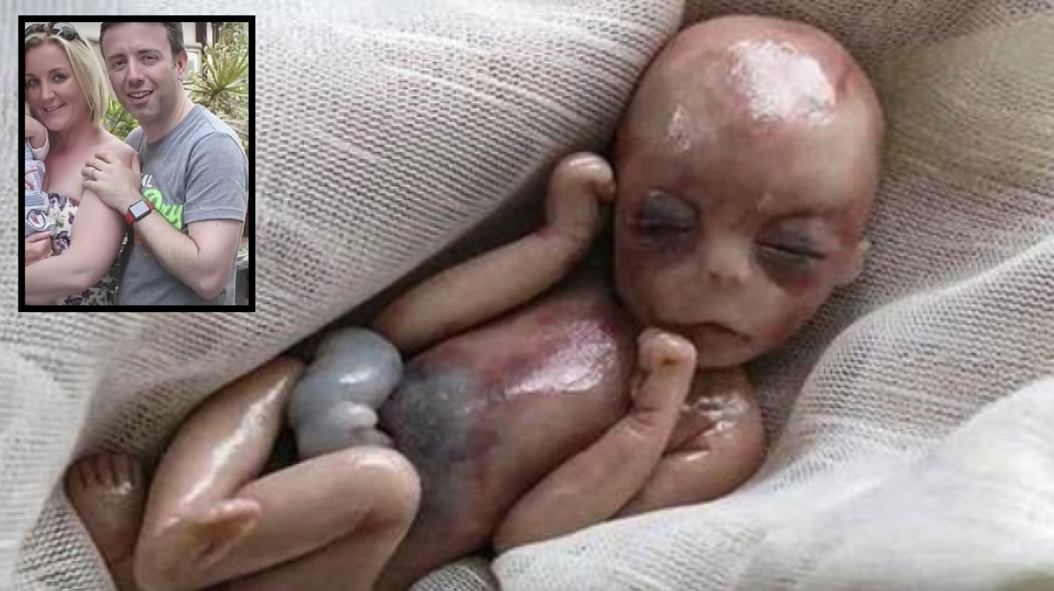 Baby Girl Dies After Heart Stops At Birth, 8 Minutes Later Doctors Stunned By Miracle - Vimarsana News