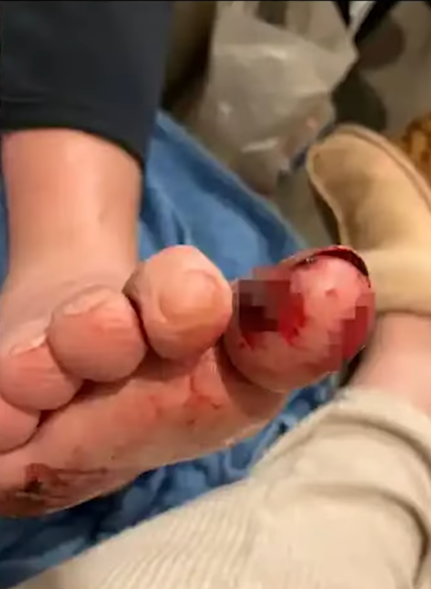 Closeup of 64-year-old David Lindsay's chewed up big toe in the hospital, Photo Credit: Daily Explorations/Youtube
