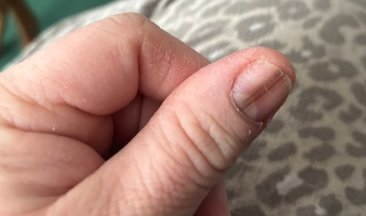 A fingernail with a brown line going across it, Photo Credit: News4JAX The Local Station/Youtube