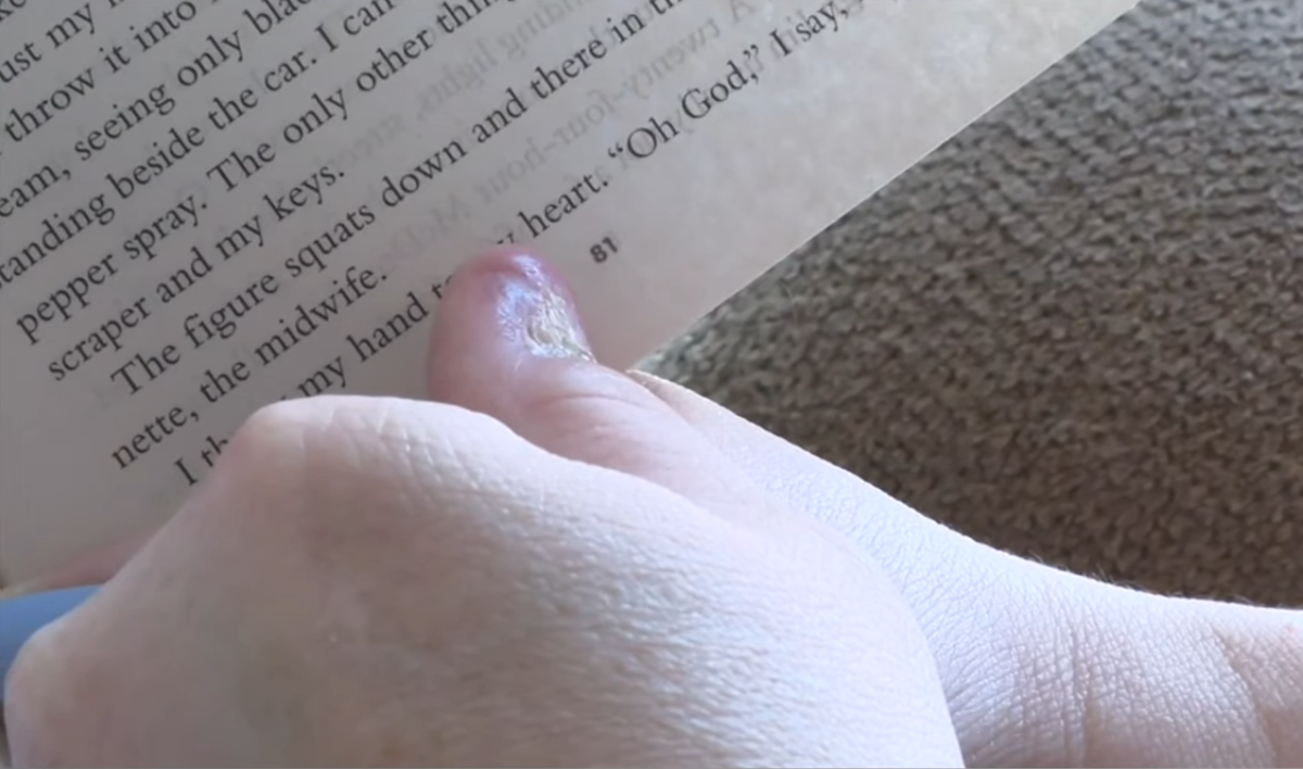 Lauren Koltcz's finger after an operation, Photo Credit: News4JAX The Local Station/Youtube