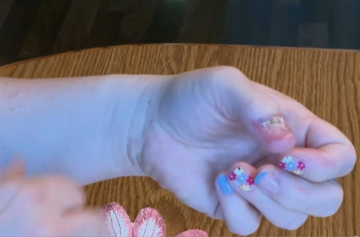 Lauren Koltcz's finger after an operation, Photo Credit: News4JAX The Local Station/Youtube