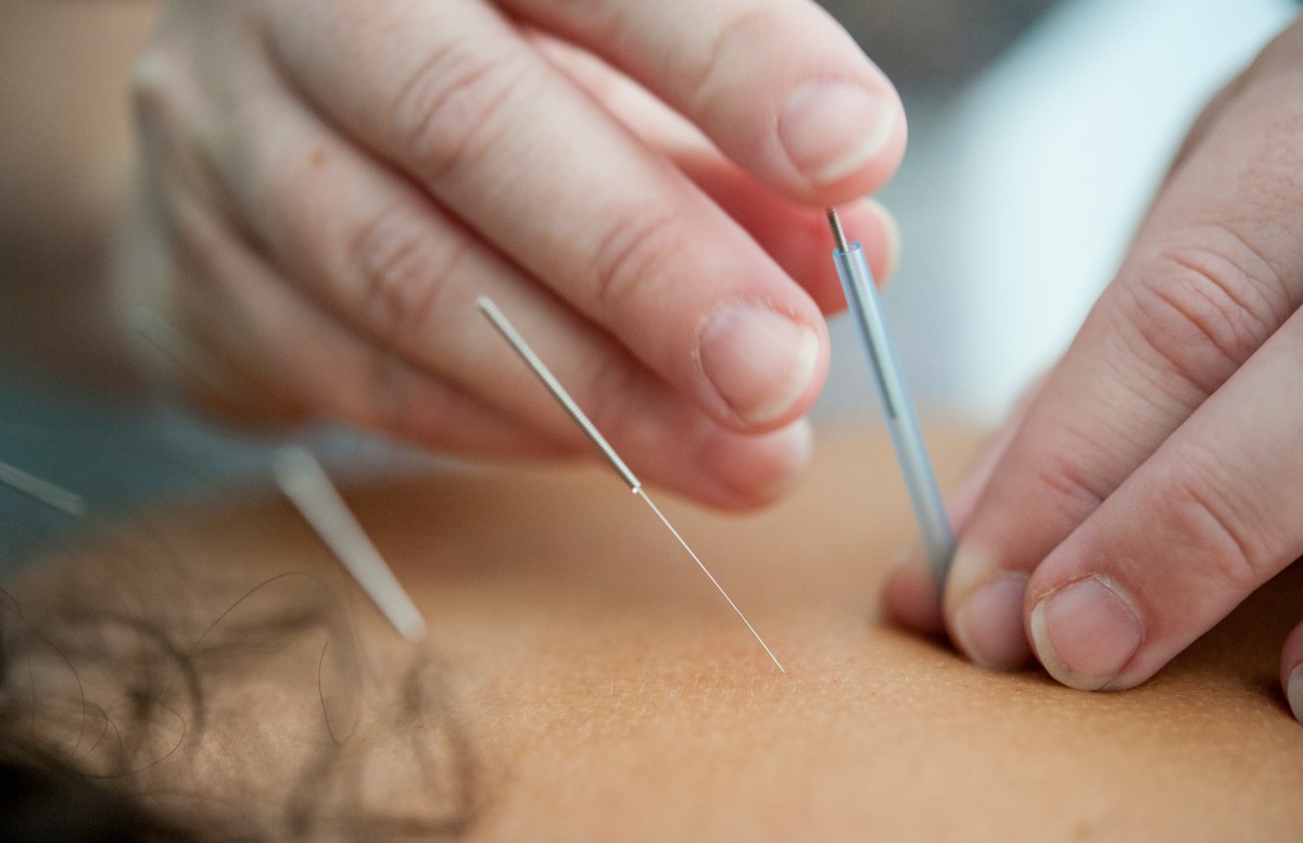 A person doing acupuncture on a person's back, Photo Credit: Unsplash