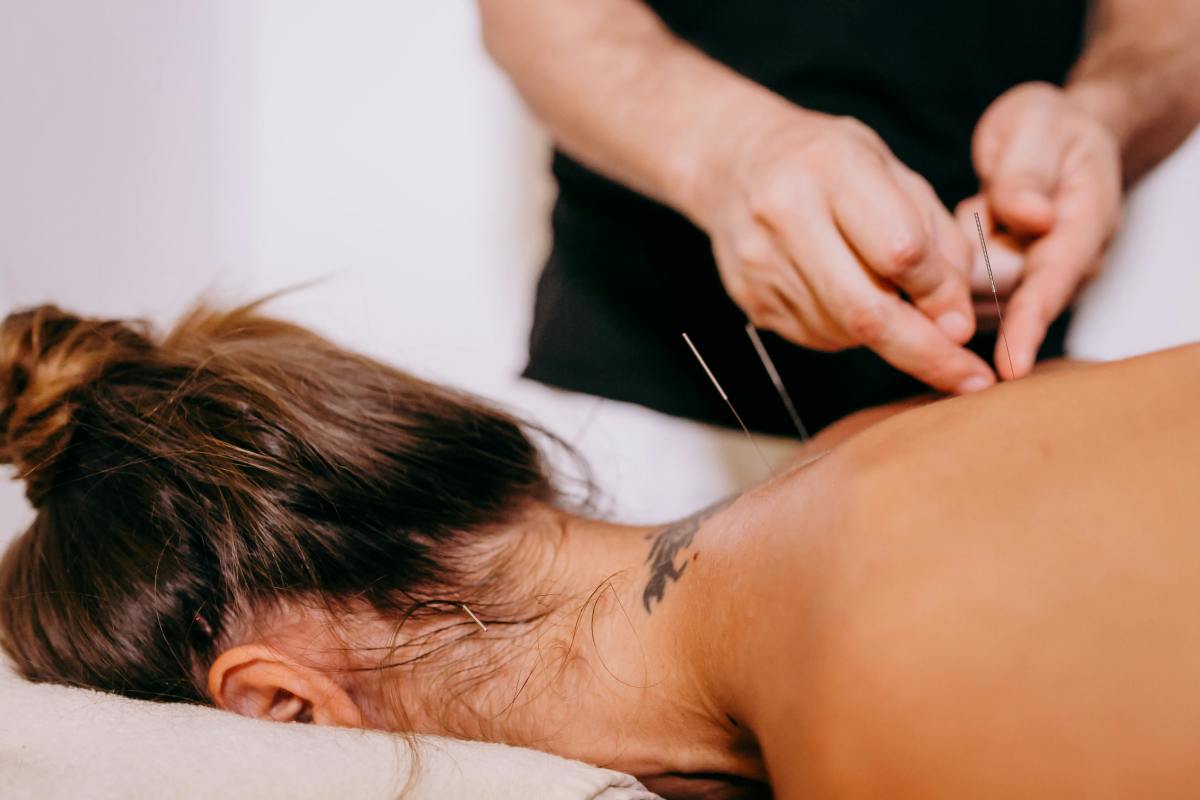 Someone putting acupuncture needles into a person's back, Photo Credit: Pexels